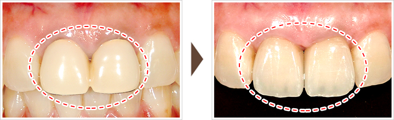 前歯2本の治療①