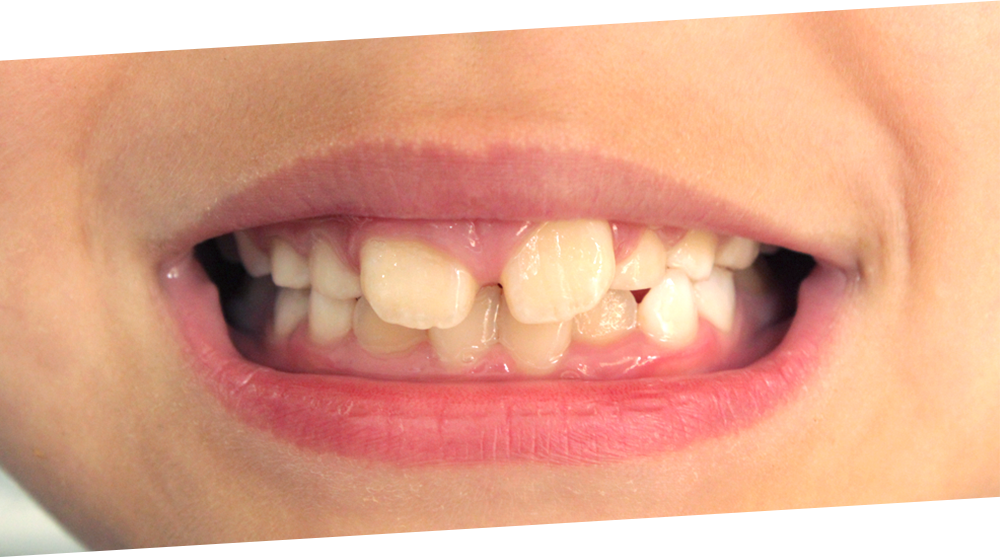 すきっ歯の治療