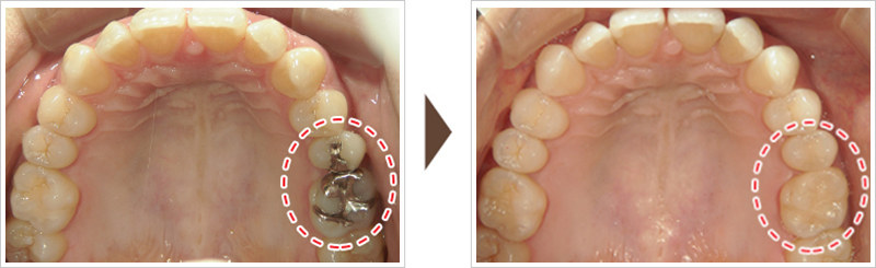 左上奥歯の治療