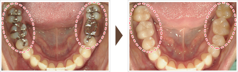 両下奥歯の治療