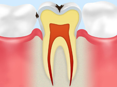 歯の表面のむし歯