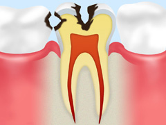 歯の神経まで進んだむし歯