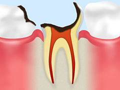 歯の中まで進んだむし歯