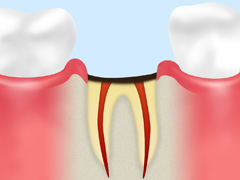 歯の根だけ残ったむし歯